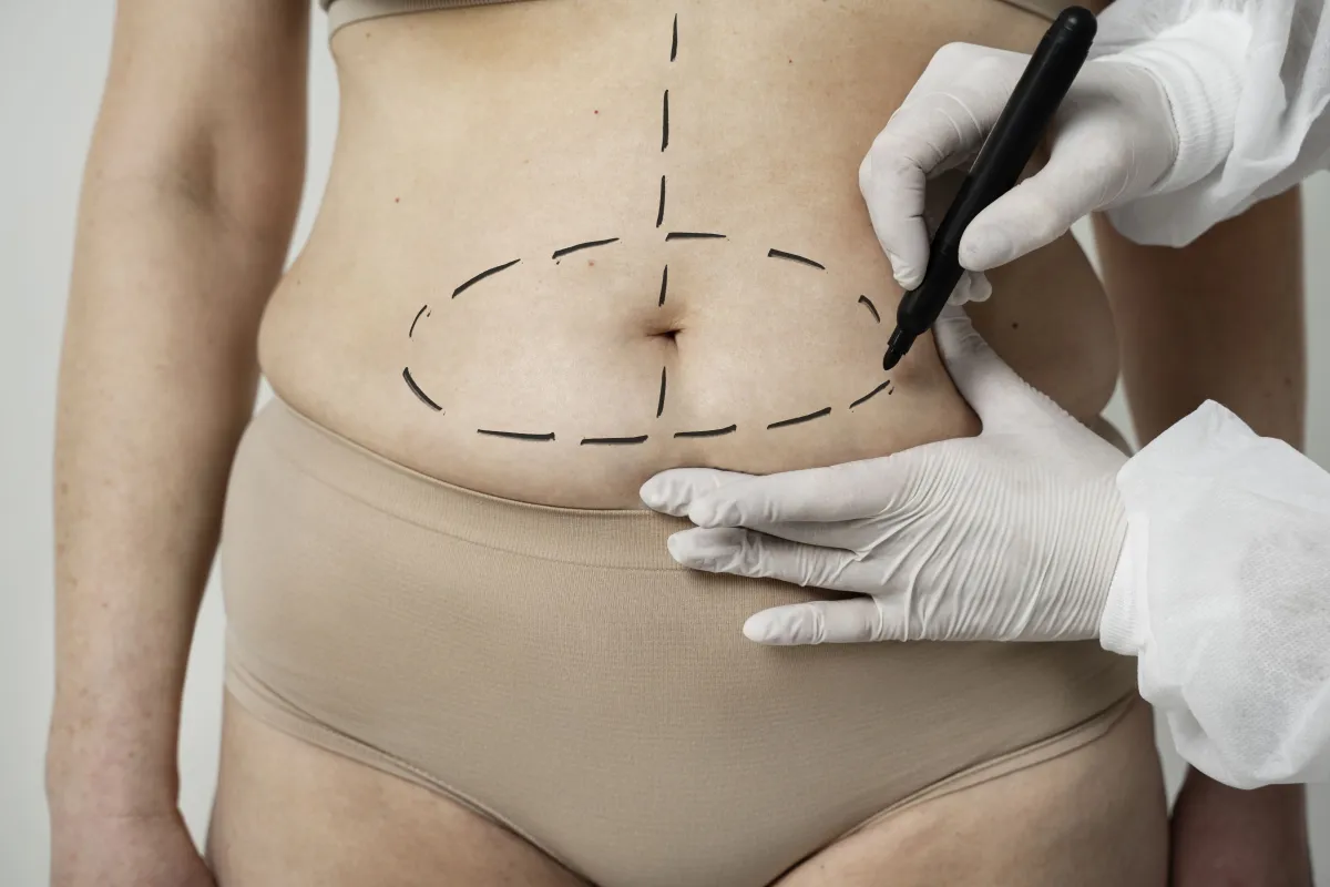 Lipoaspiração não é para emagrecer: especialistas explicam os limites e os riscos do procedimento